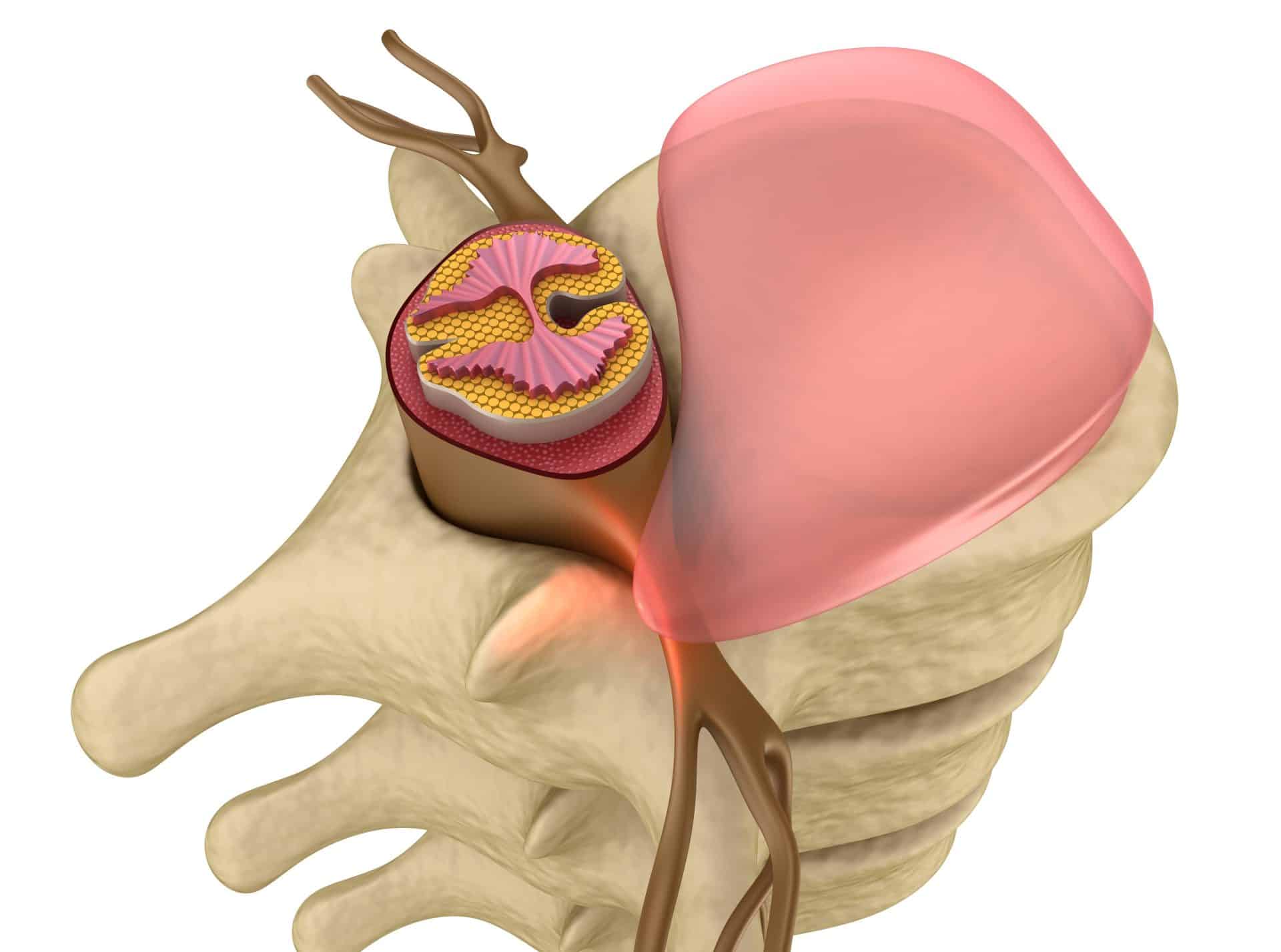 Medicina regenerativa en hernia discal: detrás de la curación mediante la respuesta inmunológica