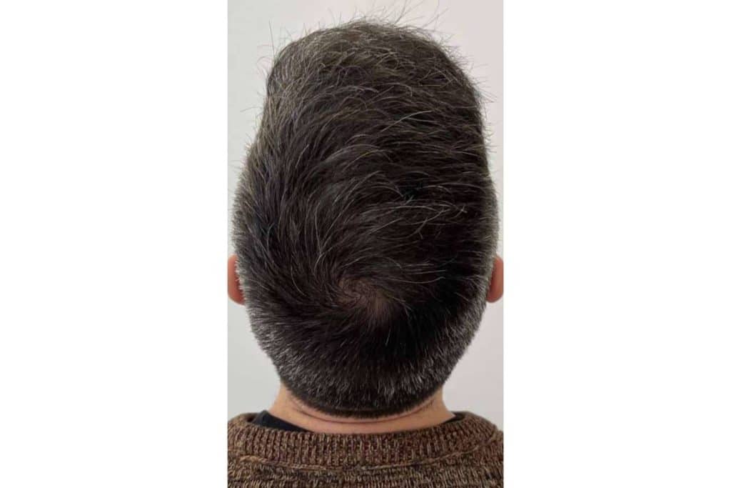 Chara Capilar en Barcelona ofrece los tratamientos más innovadores para la alopecia