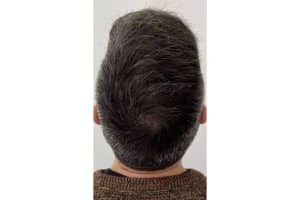 Chara Capilar en Barcelona ofrece los tratamientos más innovadores para la alopecia