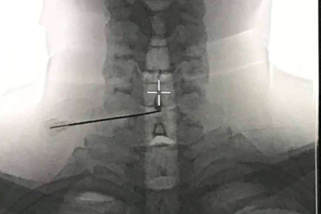 Ozonoterapia para hernia discal; el resultado se mantuvo 10 años después de la disolisis en el 88% de los casos