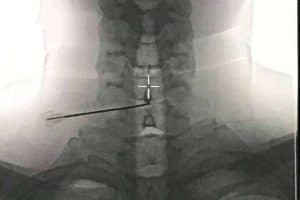 Ozonoterapia para hernia discal; el resultado se mantuvo 10 años después de la disolisis en el 88% de los casos